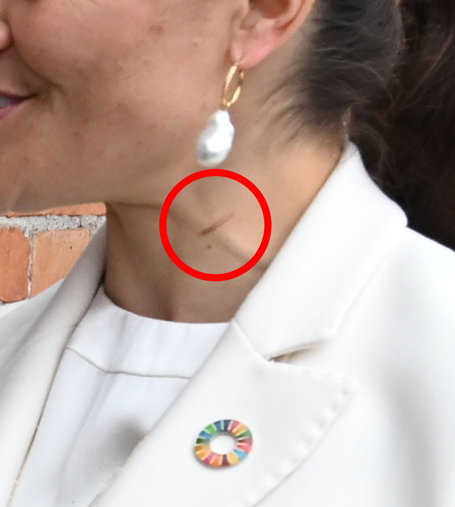 Bilderna avslöjar: Victorias märkliga blåmärke på halsen